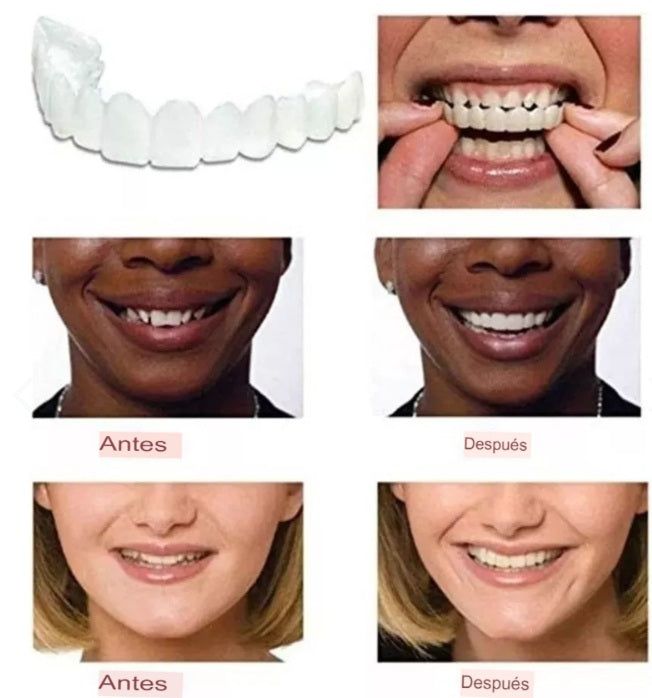 CARILLAS DENTALES-SNAP ON SMILE